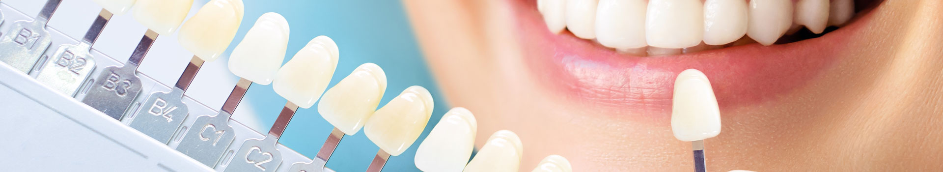 墨尔本的牙齿贴面