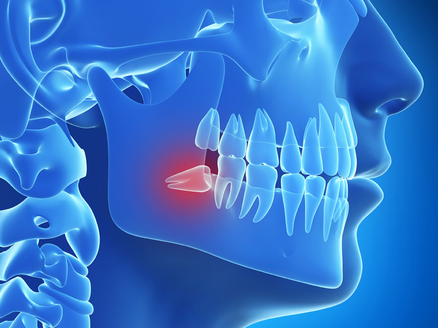 智齿手术时会发生什么？
