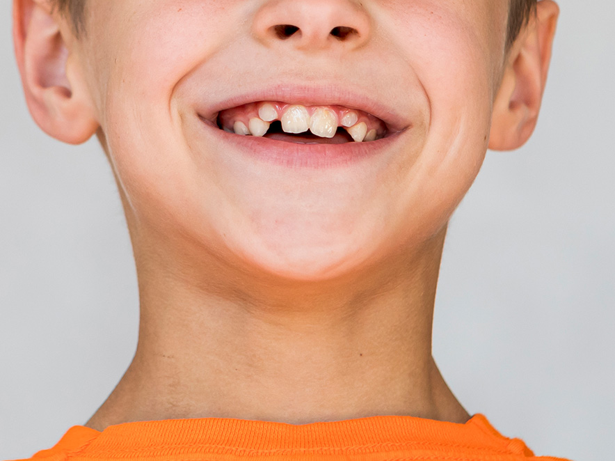 处理儿童牙齿重叠问题的重要性