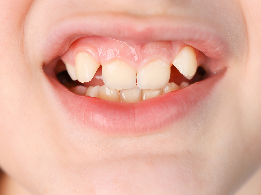 处理儿童牙齿重叠问题的重要性