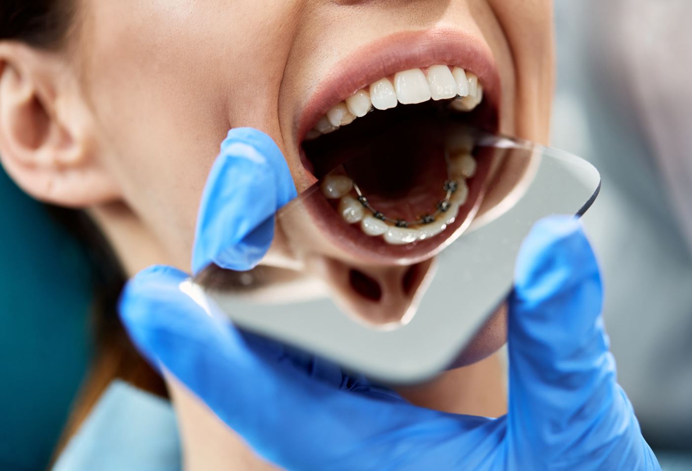 舌侧牙套 墨尔本