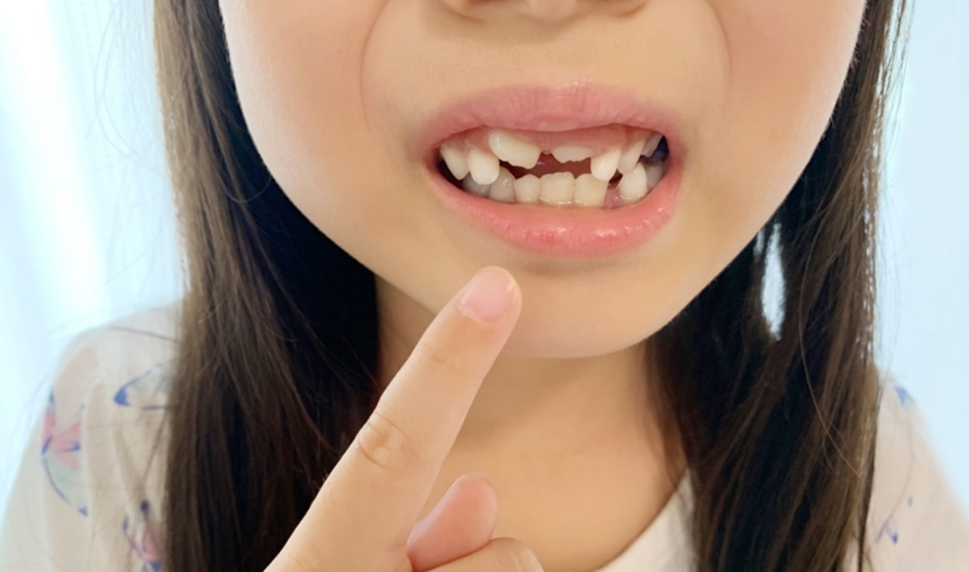 儿童牙齿不齐 墨尔本牙医