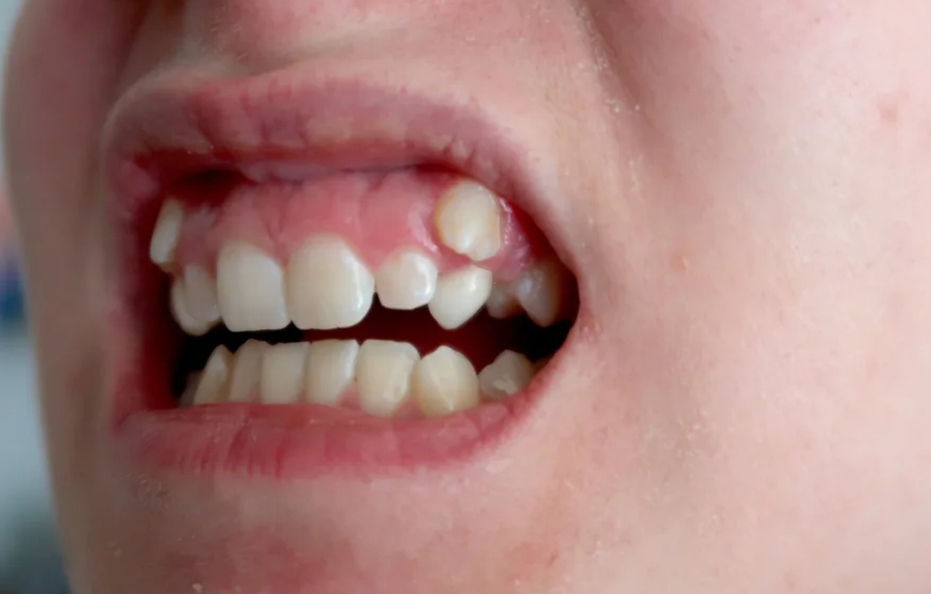 kid teeth needs orthodontics2