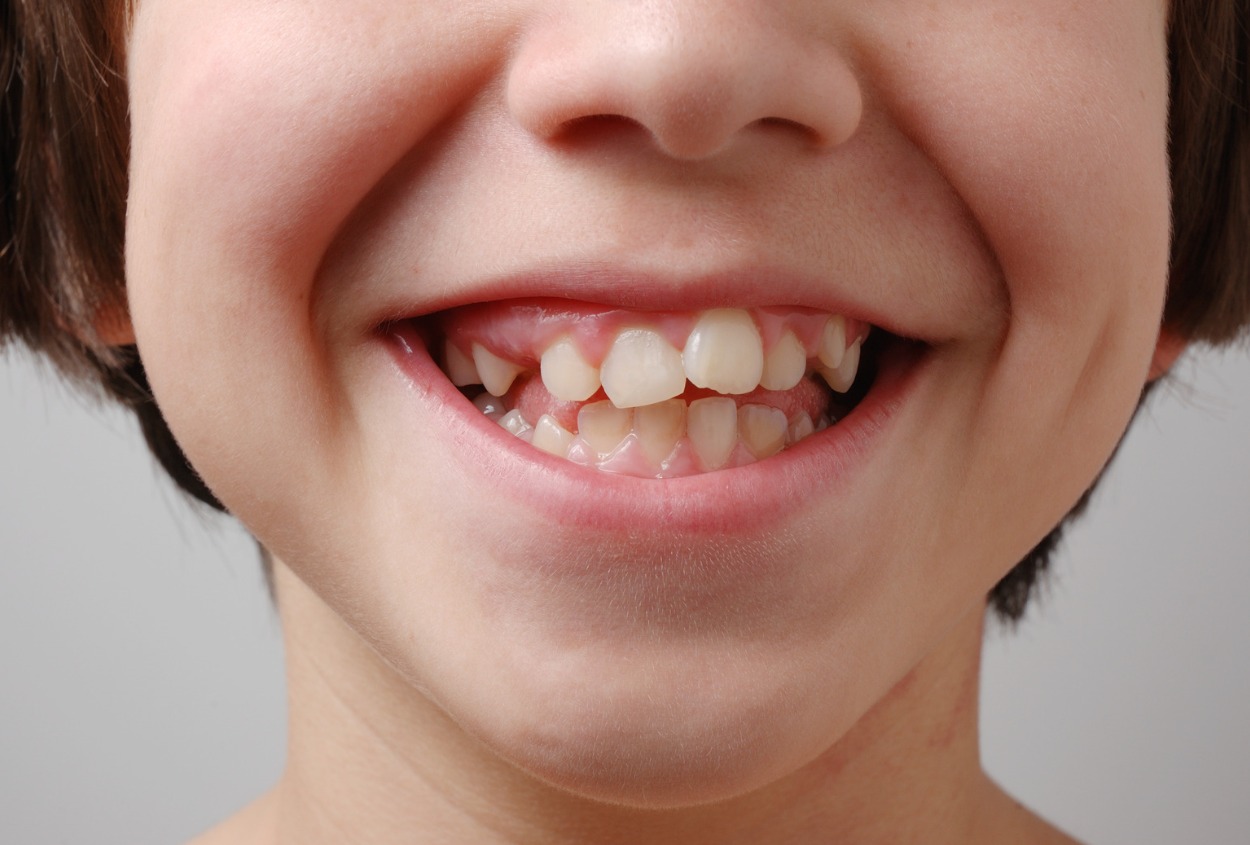 kid teeth needs orthodontics3 儿童牙齿矫正 墨尔本