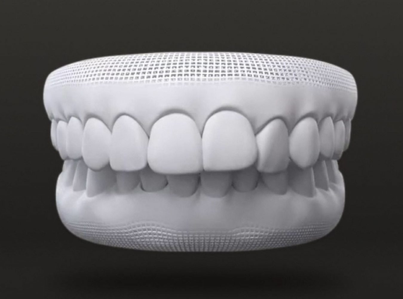 隐适美治疗龅牙