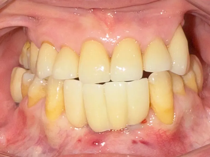 修复好的复杂牙齿状况