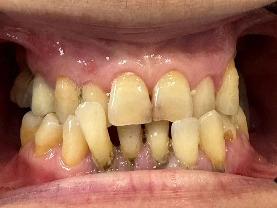 重拾您的笑容：一步一个脚印 （复杂牙科修复）